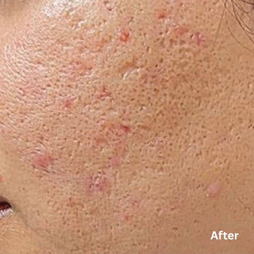 AgeJET Acne_after