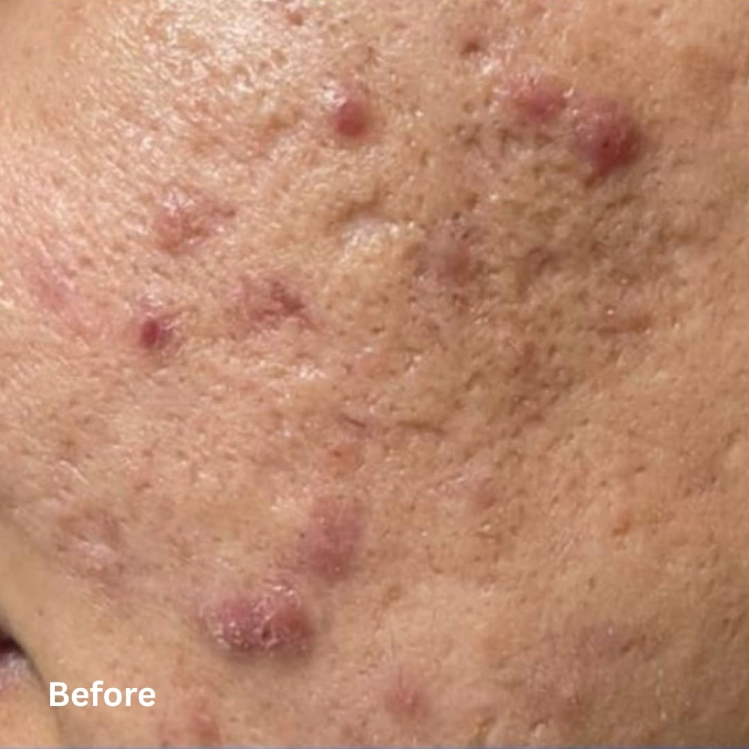 AgeJET Acne_before
