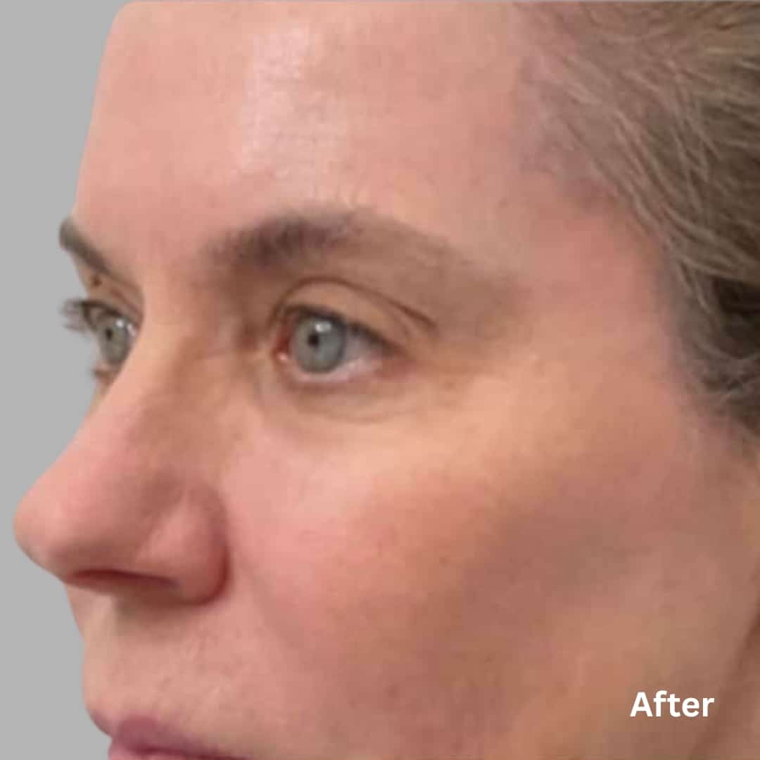 AgeJET Smooth1_after