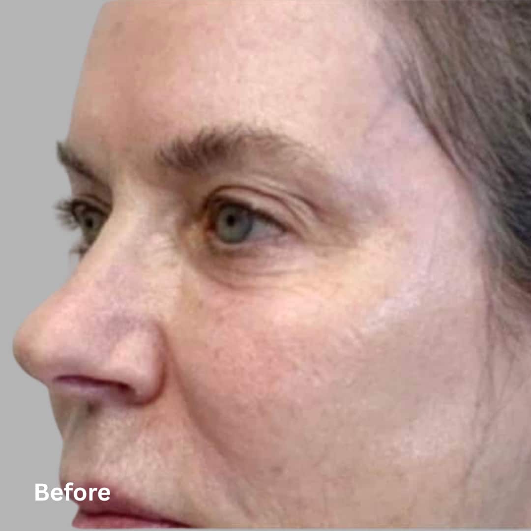 AgeJET Smooth1_before