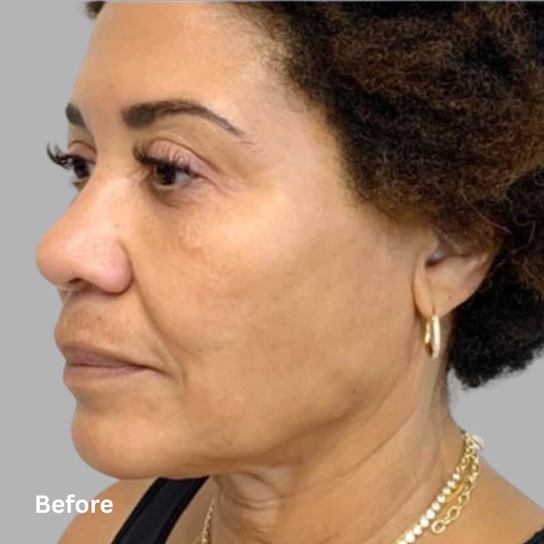 AgeJET Smooth2_before