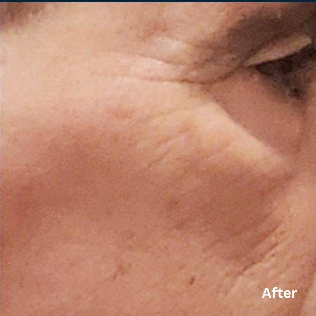 AgeJET Smooth3_after