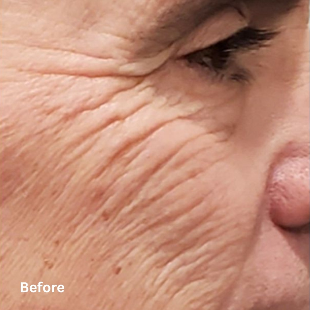 AgeJET Smooth3_before