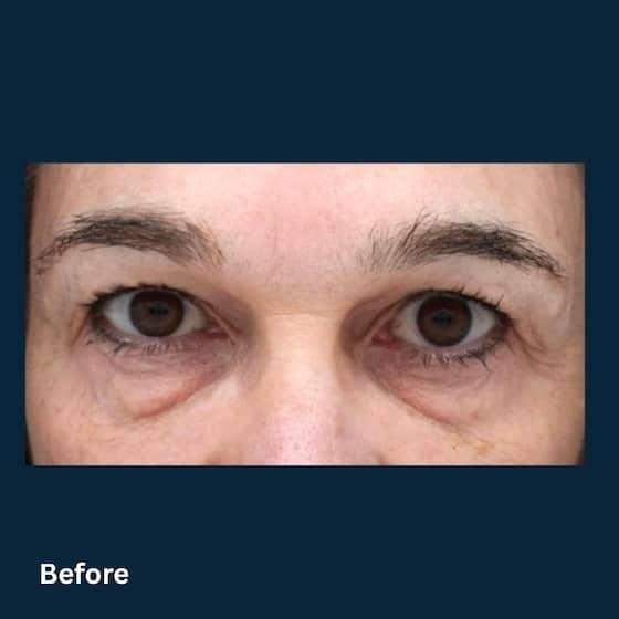 AgeJET Eyes_before