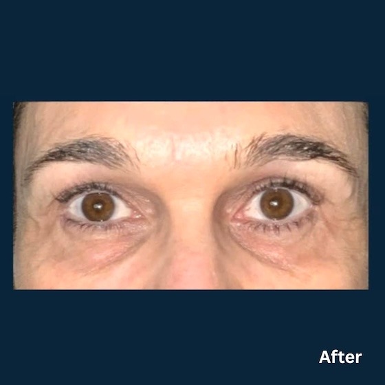 AgeJET eyes_after