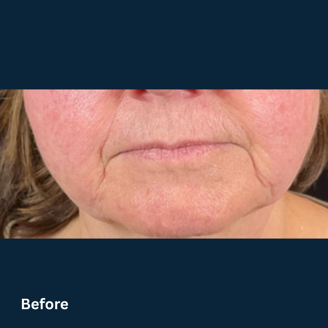 AgeJET3_before