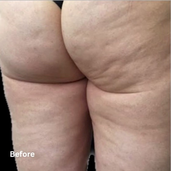 Cellulite Reduction_before