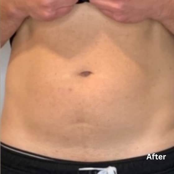 Fat Reduction-2_after