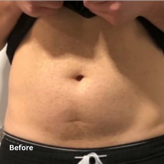 Fat Reduction-2_before