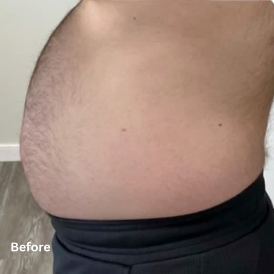 Fat Reduction_before