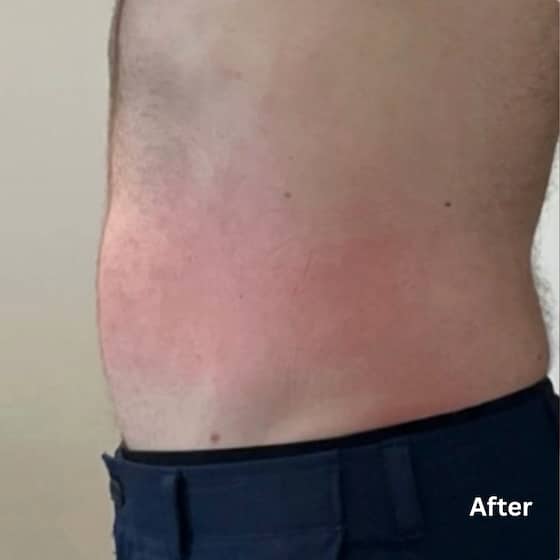 Fat Reduction_after