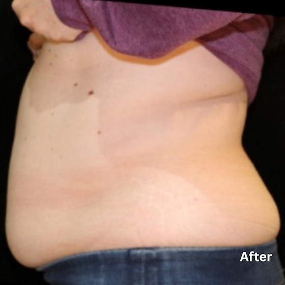 Body Contouring Slides - 1