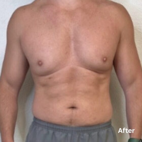 Muscle Toning_after