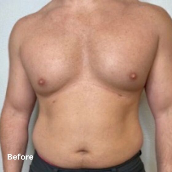 Muscle Toning _before