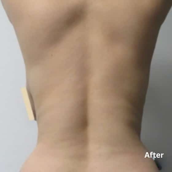 Skin Tightening_after