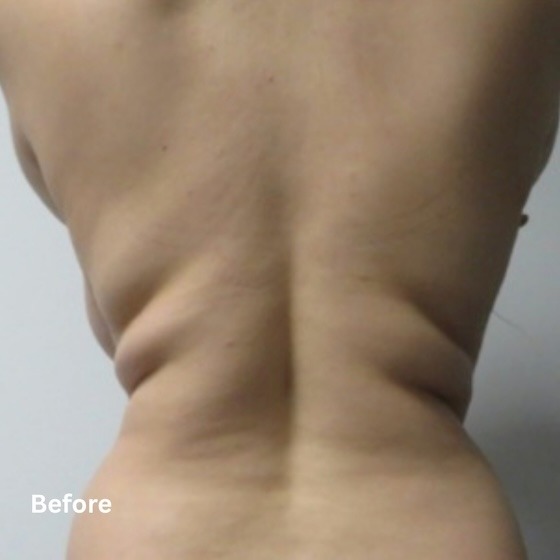 Skin Tightening_before