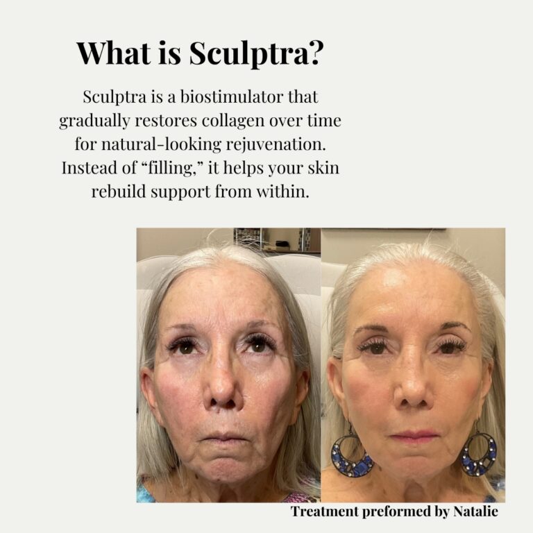 Natalie Sculptra Results(1)