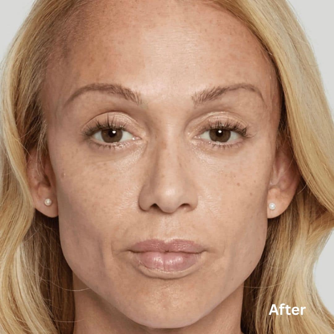 SculptraBefore-After