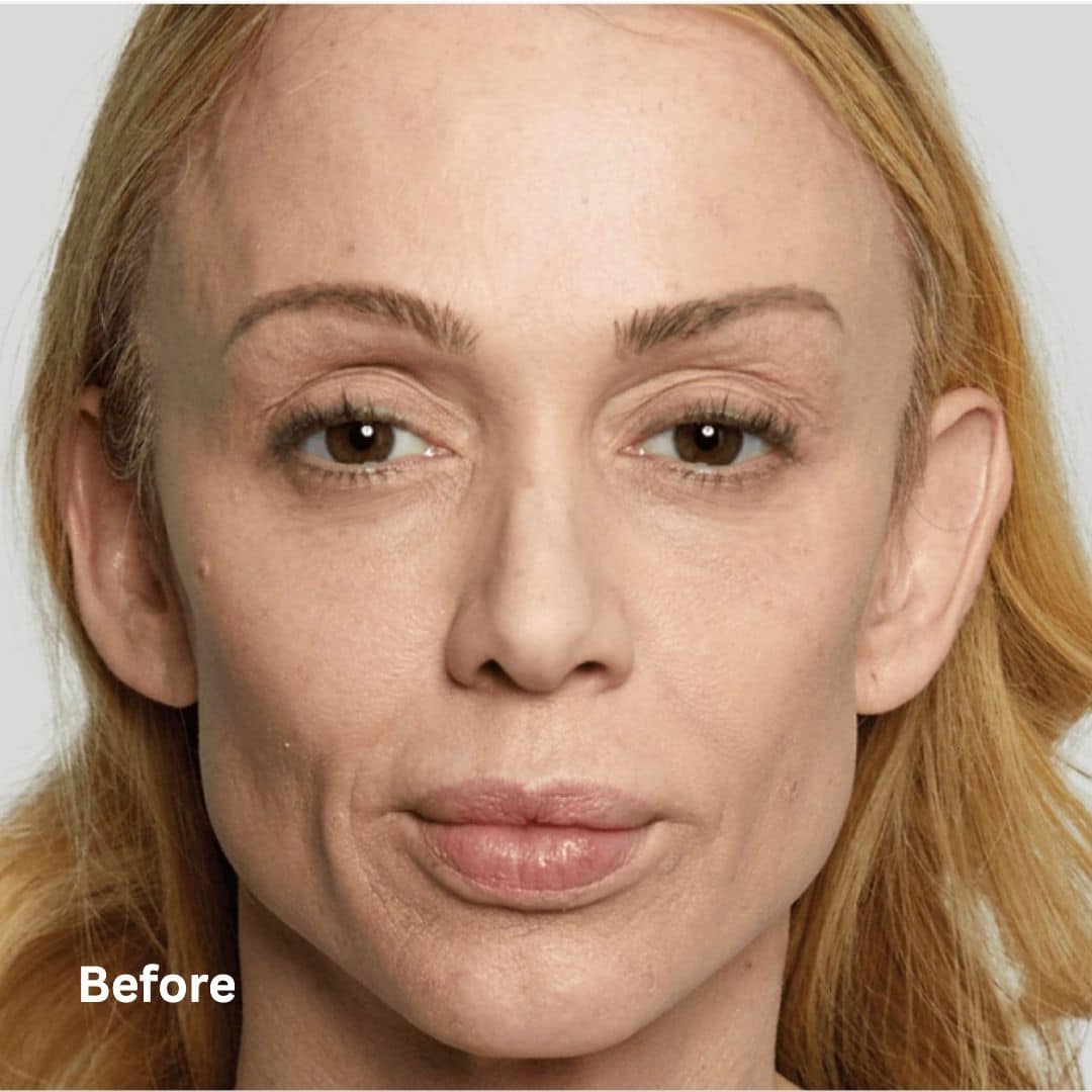 SculptraBefore1