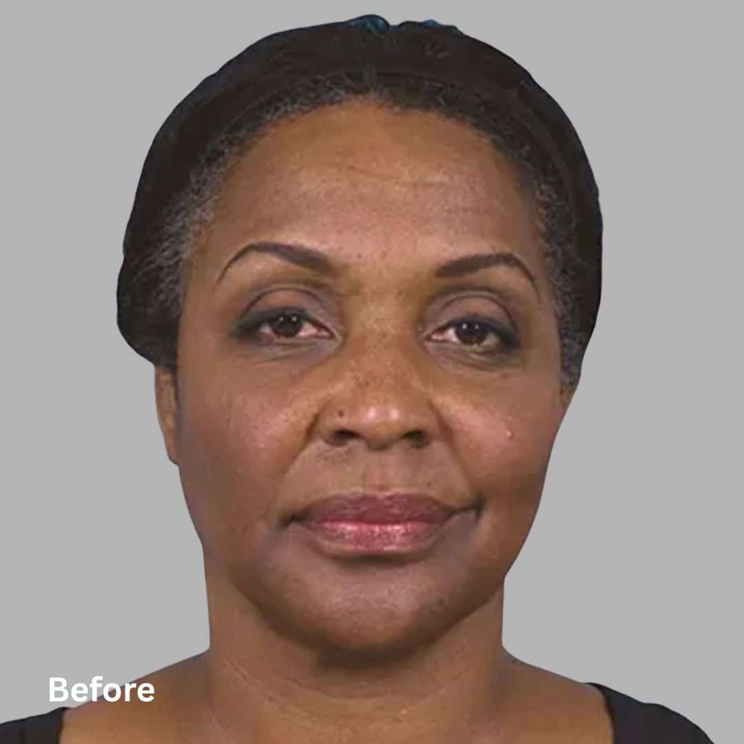 Sculptra_Before2