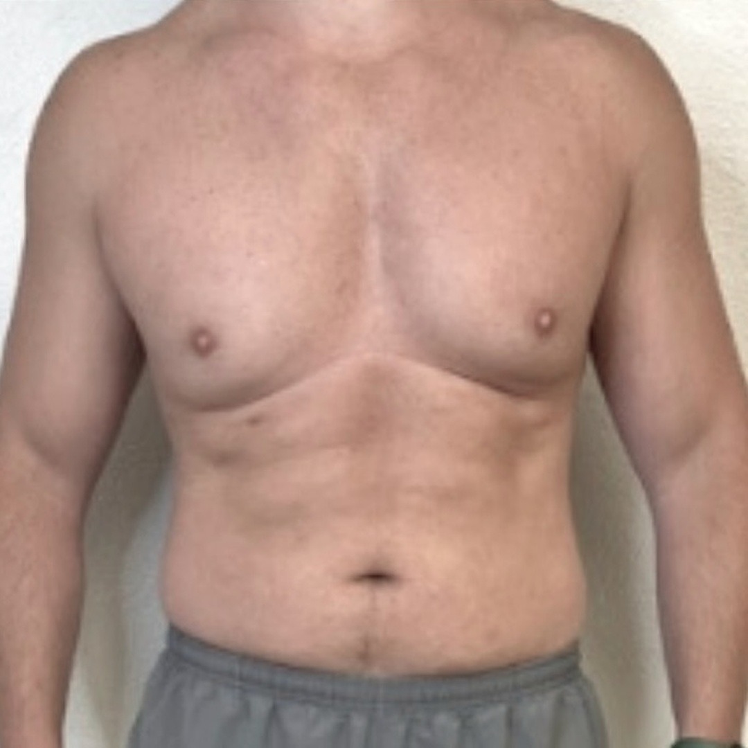 Body Contouring Slides - 1