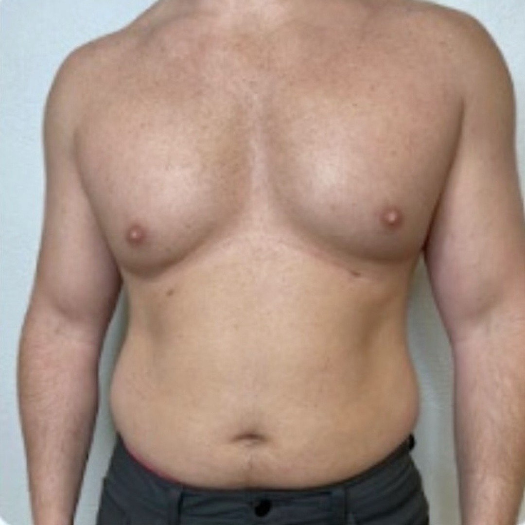 Body Contouring Slides - 2